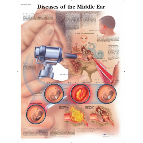 Diseases of the Middle Ear Wall Chart