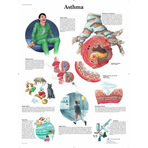 Asthma Wall Chart